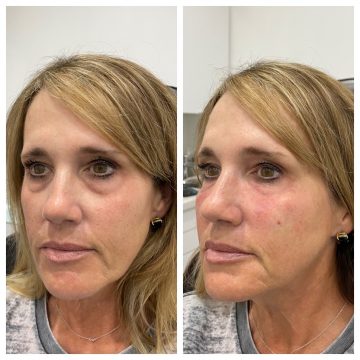 under eye example - left side