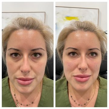 under eye example - front