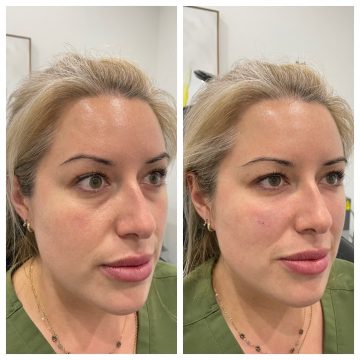 under eye example - right side