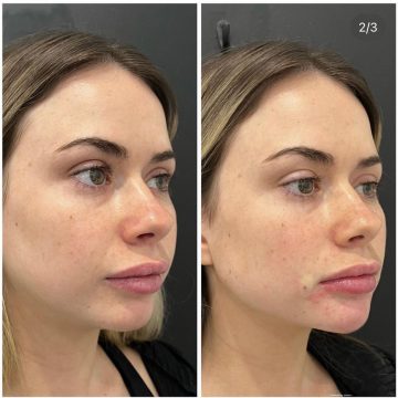 jaw and chin filler