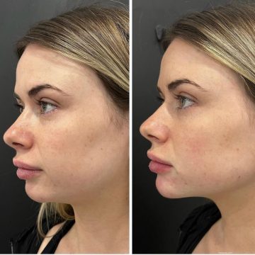 jaw and chin filler