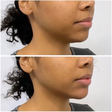 3 syringes of chin and jawline filler