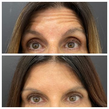 15 units Botox to forehead
