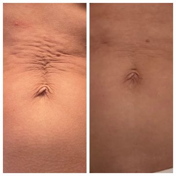 Before an after 3 sessions of radiofrequency microneedling