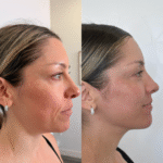 moxi before and after treatment at synerchi
