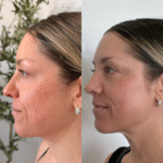 moxi before and after treatment at synerchi