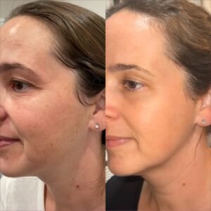 bbl moxi model before and after