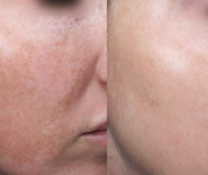 growth factor before and after