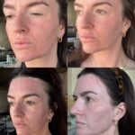 avava post treatment