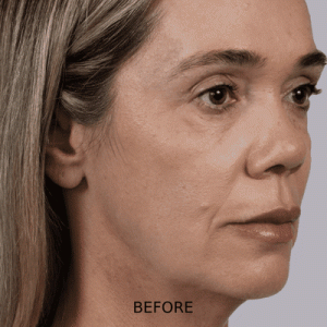 sculptra before_after