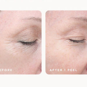 vi peel before and after eye area